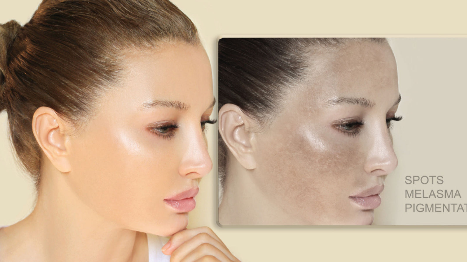 Hyperpigmentation: How To Recognize It & Reverse It